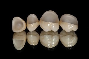 Những đặc điểm của răng sứ không kim loại