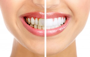 Cách khắc phục răng nhiễm Tetracycline 2