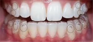 Hiệu quả niềng răng không mắc cài invisalign 