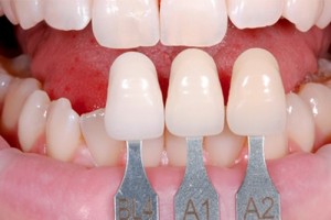 Quy trình bọc răng sứ an toàn, hiệu quả
