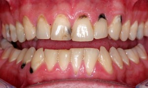 Răng đổi màu và cách điều trị