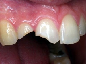 Khi nào nên bọc răng sứ thẩm mỹ?