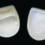 Thời gian bảo hành của răng sứ cercon là bao lâu?
