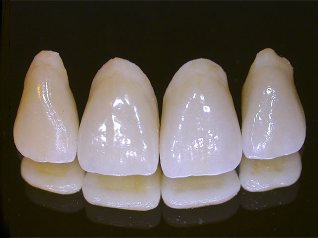 Các vật liệu kim loại làm răng giả trong nha khoa