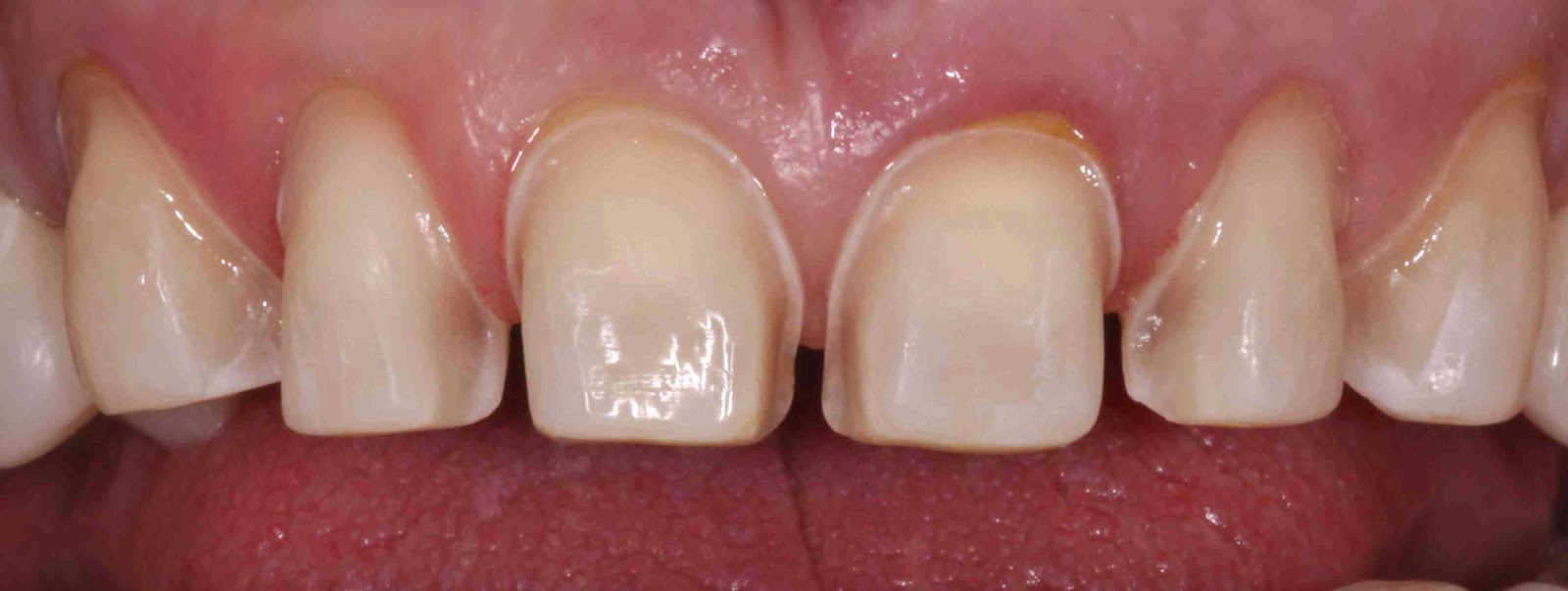 Điều trị răng nhiễm Tetra