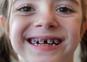 Những điều cần biết khi niềng răng cho trẻ em