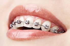Quy trình niềng răng bằng mắc cài kim loại 