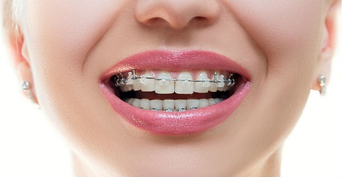 Ưu điểm của niềng răng mắc cài sứ 2 Ưu điểm của niềng răng mắc cài sứ 2