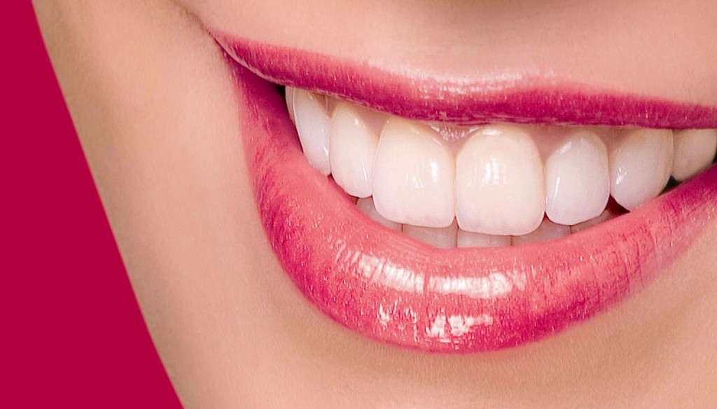 Ưu điểm của niềng răng mắc cài sứ Ưu điểm của niềng răng mắc cài sứ