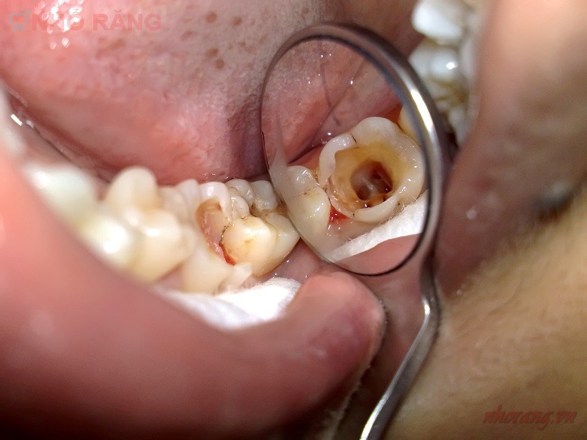 Trường hợp nào bọc răng sứ ?