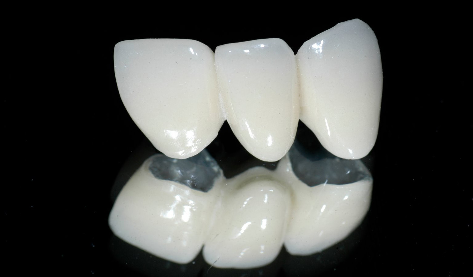Ưu điểm bọc răng toàn sứ với công nghệ CT 5
