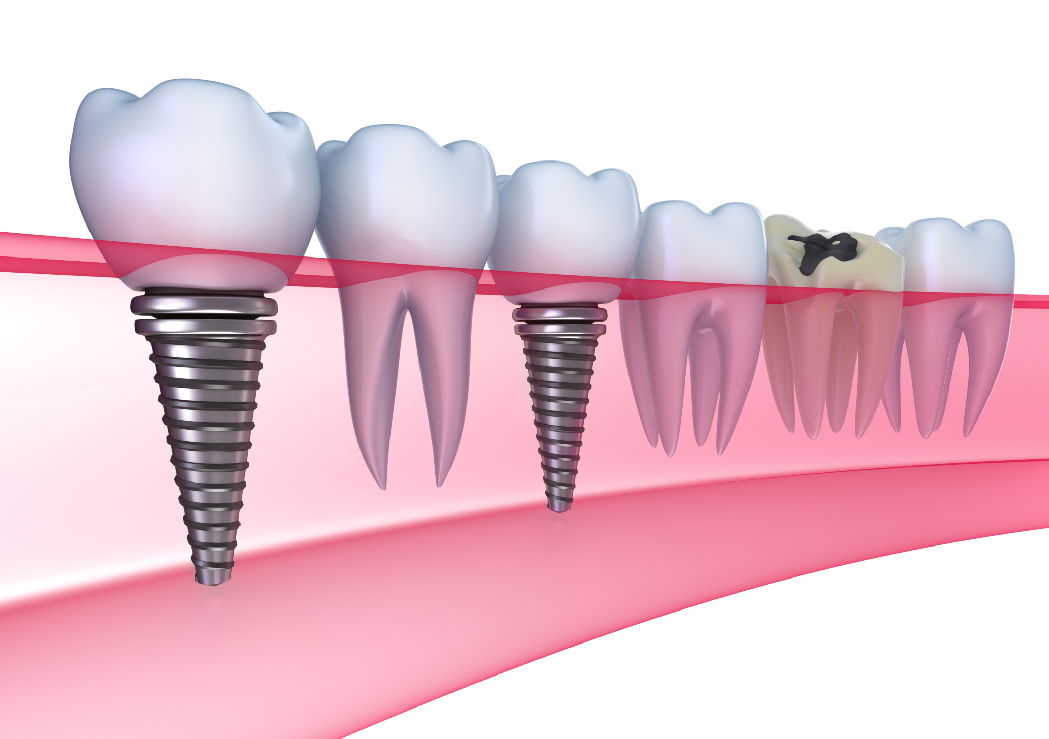 Cấy ghép implant thay thế nhiều răng