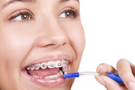 Niềng răng thẩm mỹ có hiệu quả không ?