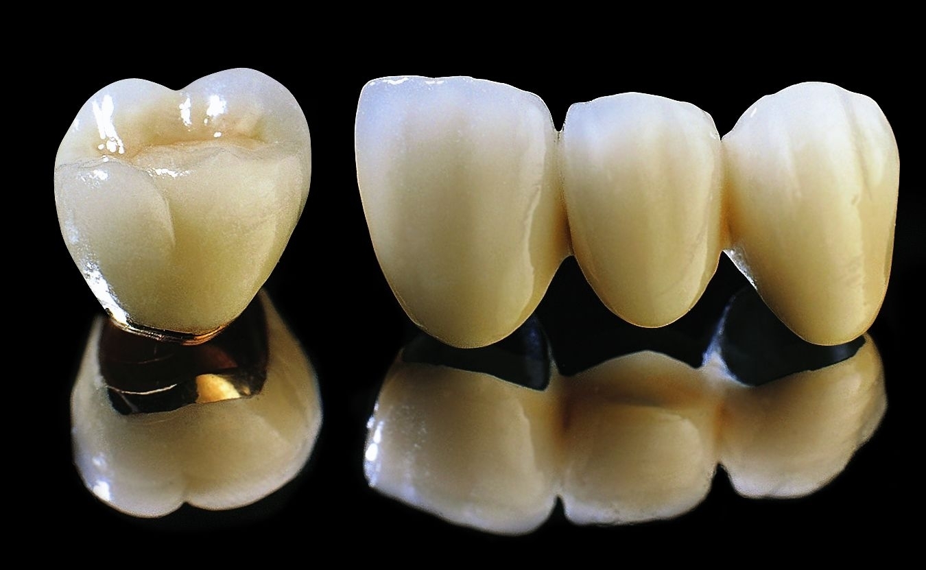Răng sứ titan bảo tồn trong bao lâu ?