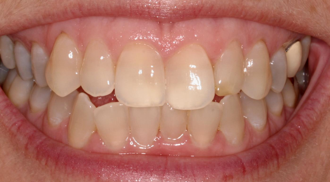 Tác hại của bệnh viêm nướu răng