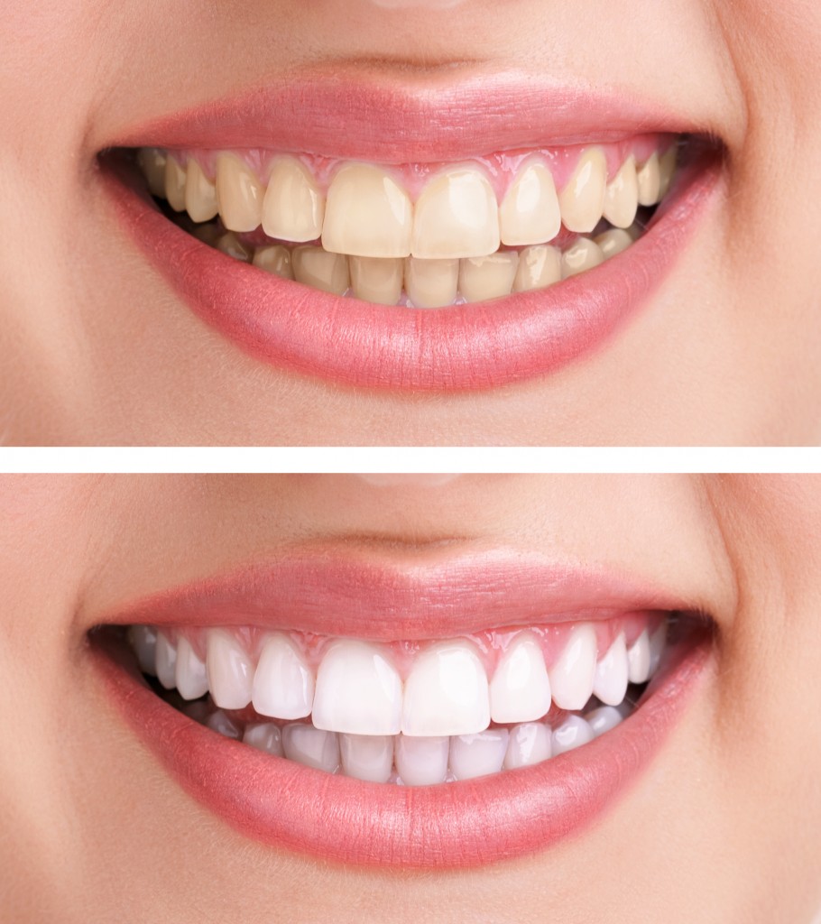 Tẩy trắng răng bằng công nghệ Brite Smile