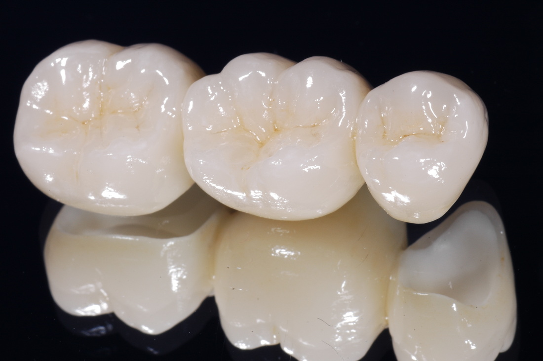 Những thắc mắc khi trồng răng sức loại răng giả