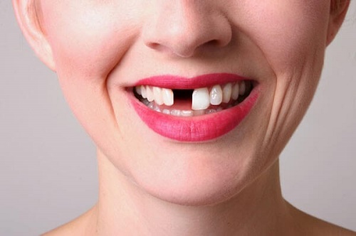 Đối tượng nào không nên trồng răng implant? 2