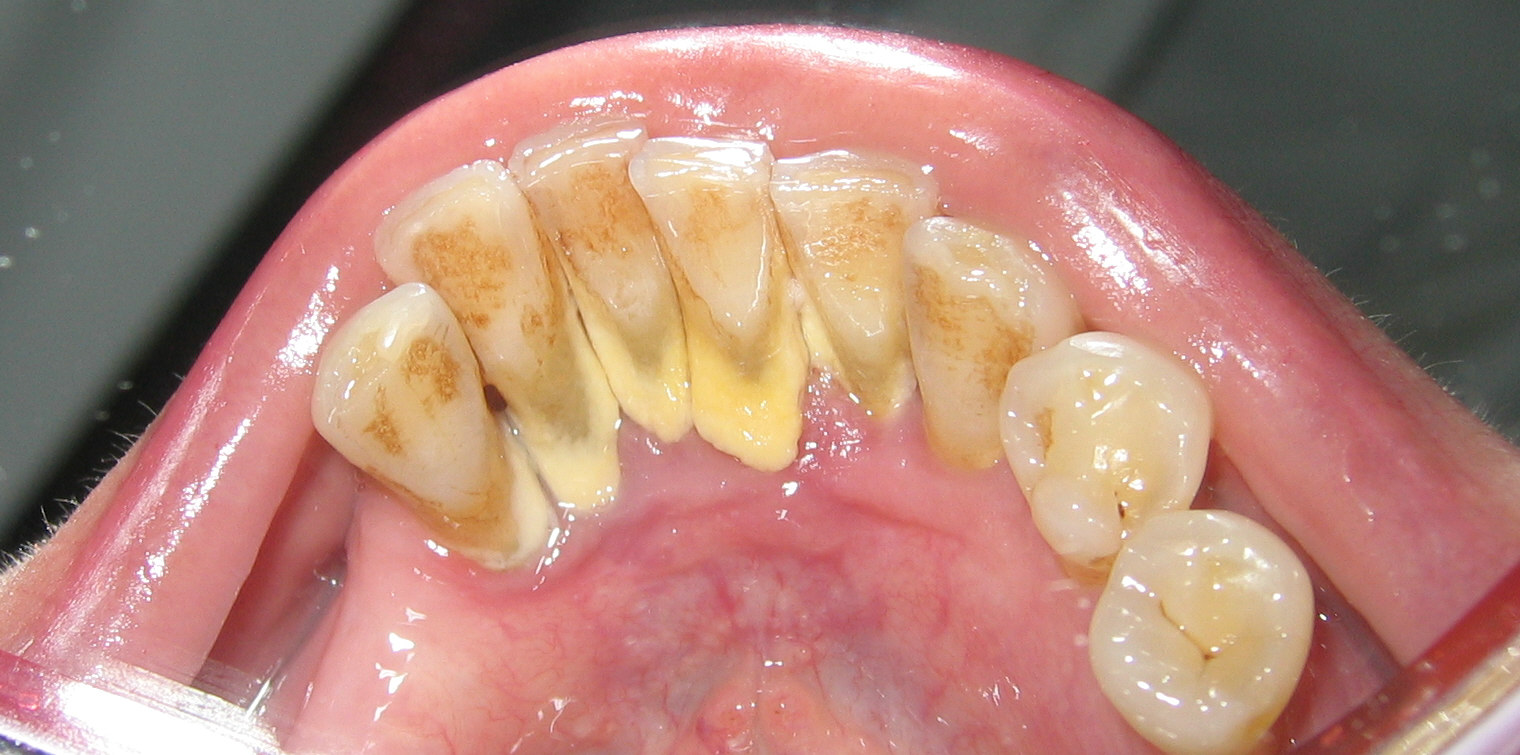 Lấy vôi răng có làm mòn răng không ?