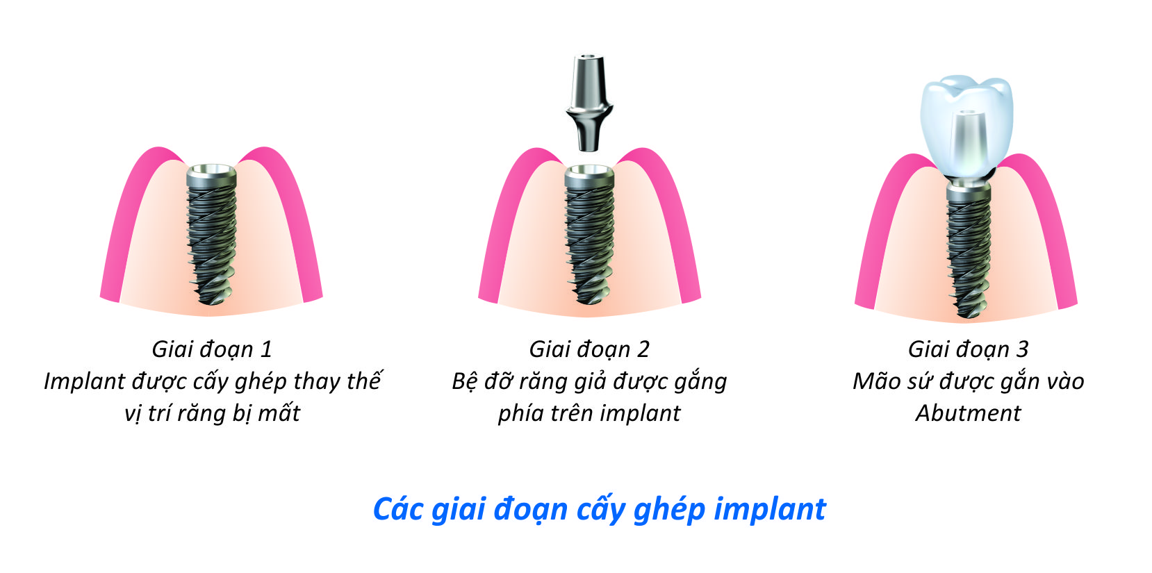 Cấy ghép Implant được thực hiện như thế nào ?