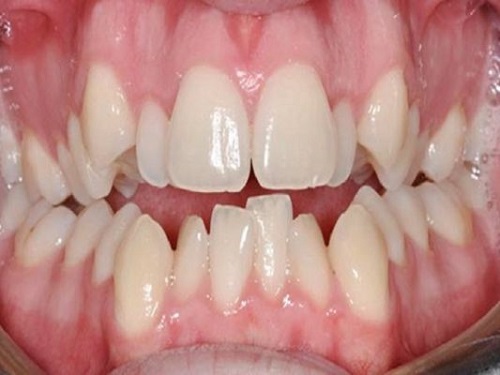 Ưu điểm của kỹ thuật niềng răng mắc cài 3M UGSL-1