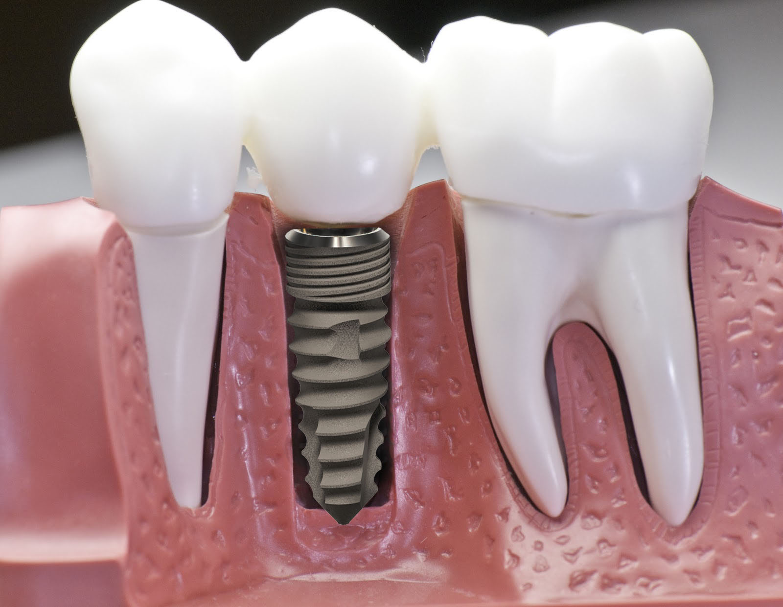Sự khác nhau giữa cấy ghép implant và bọc răng sứ