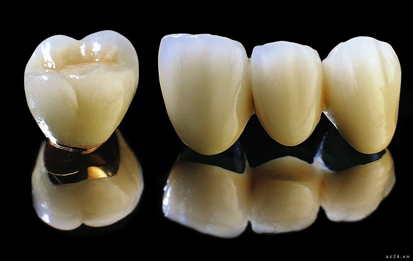 Quy trình bọc răng sứ titan như thế nào ? 1