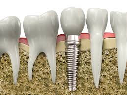 Quy trình cấy ghép implant 4S 