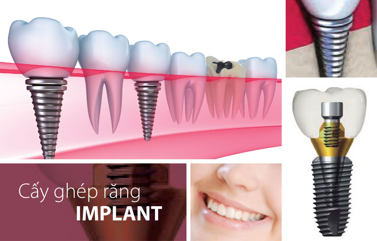 Giải pháp trồng răng Implant khi mất răng toàn hàm