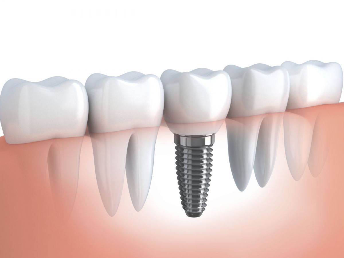 Lưu ý về vệ sinh răng miệng khi cấy ghép implant