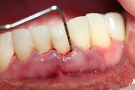 Cách khắc phục viêm lợi sau khi bọc răng sứ 1