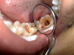 Những lưu ý khi bị sâu răng