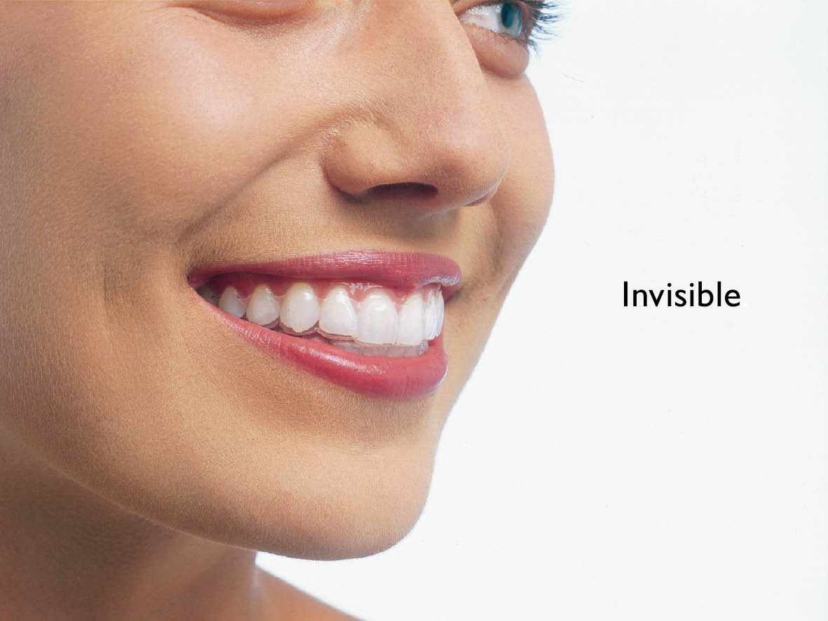 Niềng răng Invisalign có tốt không ?
