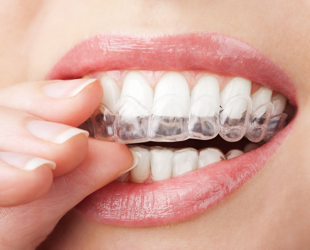 Nên niềng răng không mắc cài ở đâu ? Nên niềng răng không mắc cài ở đâu ?