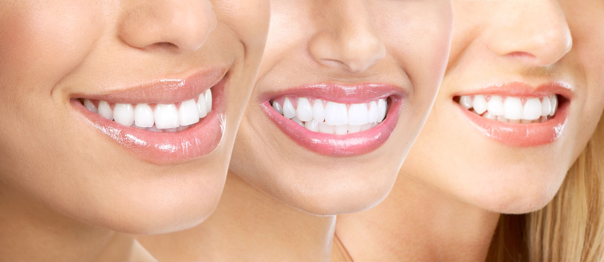 Tẩy trắng răng cho răng sứ có được không ?