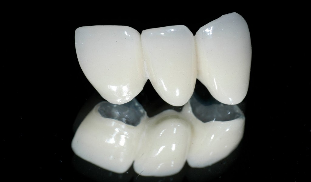 Quy trình bọc răng sứ như thế nào? 2
