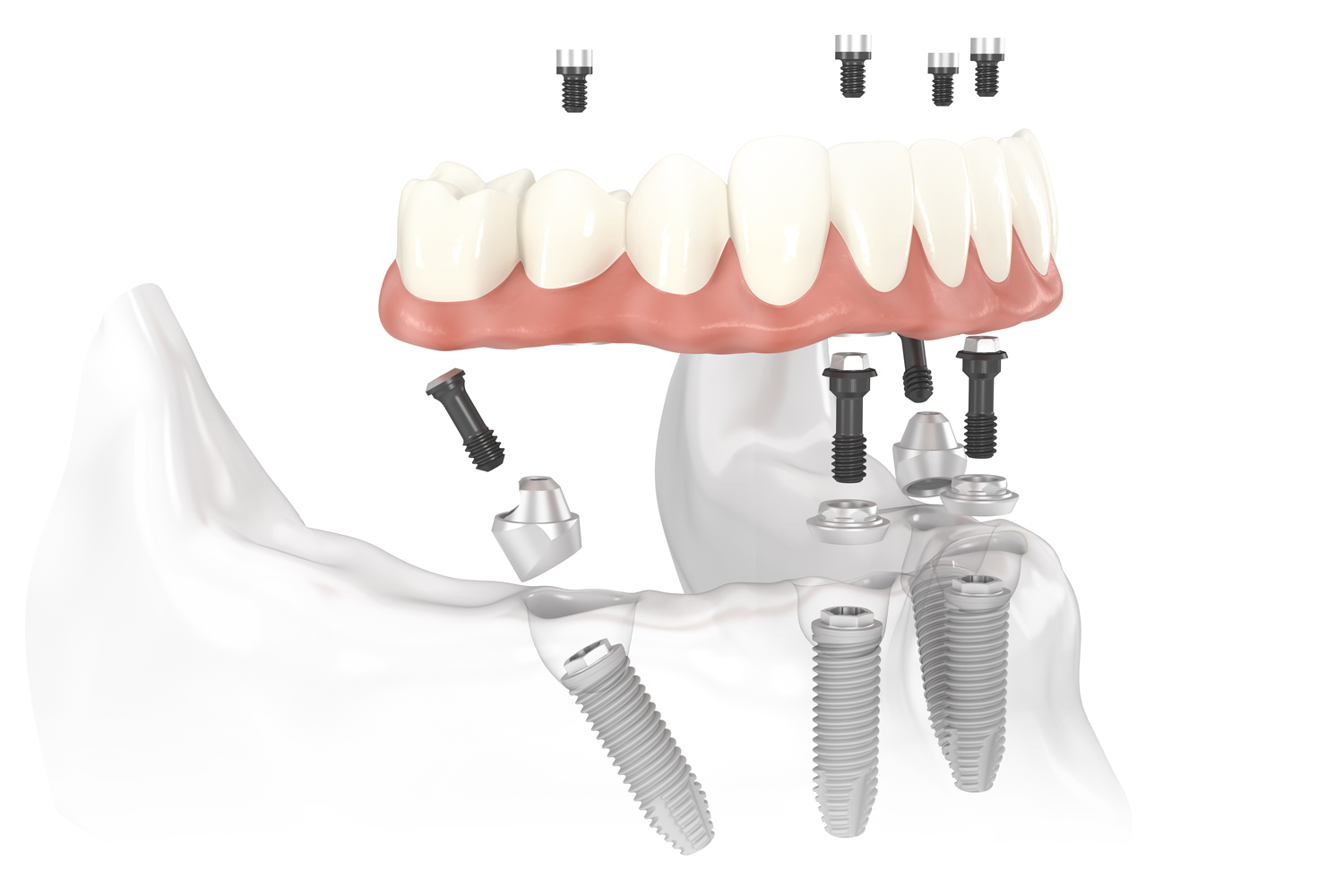 Trồng răng implant ở đâu tốt? 1