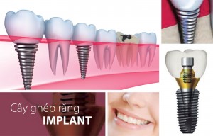 Cấy ghép răng implant không đau
