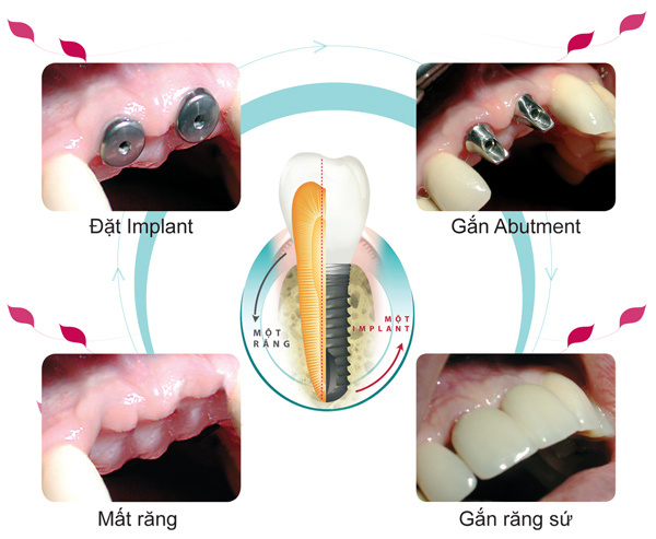 Trồng răng implant mất bao lâu ? 3