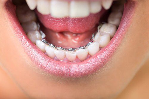 Quy trình niềng răng mặt trong