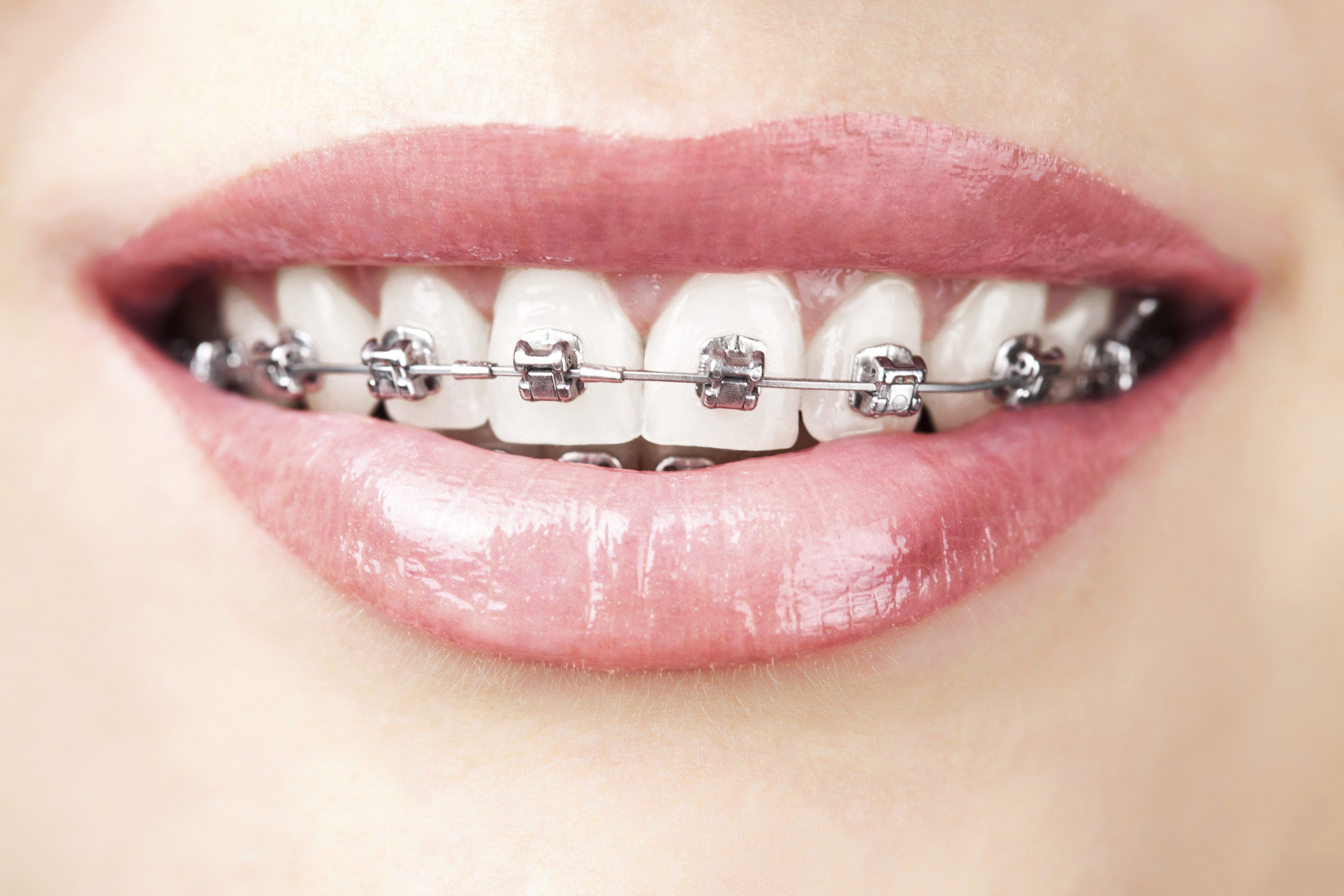 Niềng răng mắc cài inox hiệu quả không ?