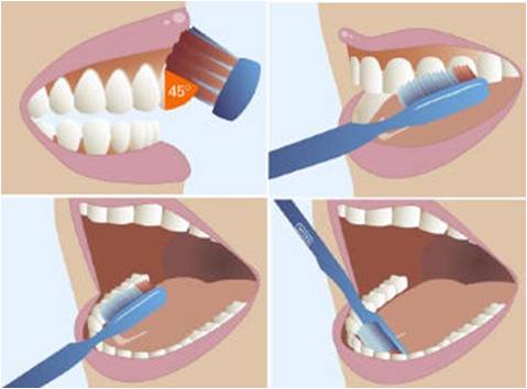 Các bước làm sạch răng Implant đúng cách