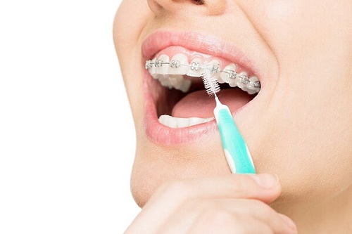 Chi phí niềng răng hô hàm trên 2