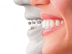 Cách chỉnh răng vẩu bằng niềng răng mắc cài Cách chỉnh răng vẩu bằng niềng răng mắc cài
