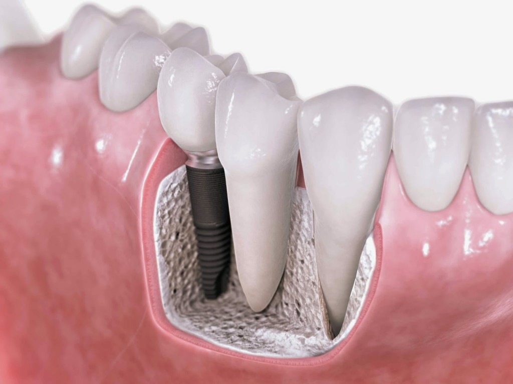 Đau nhức khi trồng răng implant 3