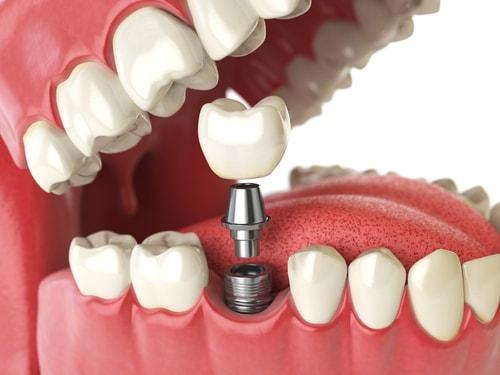 Kỹ thuật trồng răng Implant 1