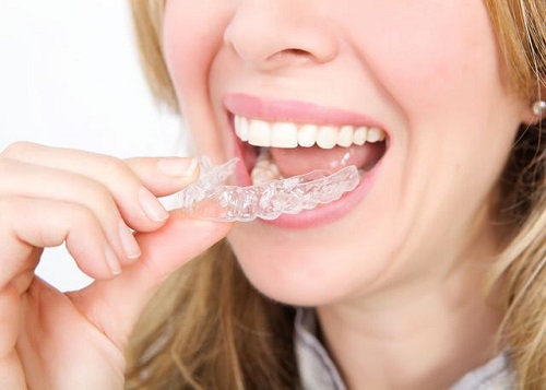 Chi phí niềng răng tháo lắp giá bao nhiêu tiền?-3 Chi phí niềng răng tháo lắp giá bao nhiêu tiền?-3