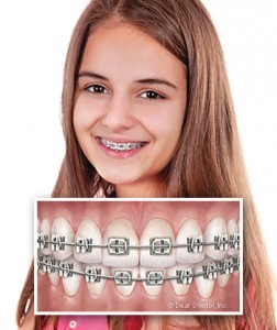 Điều trị hô bằng niềng răng thẩm mỹ
