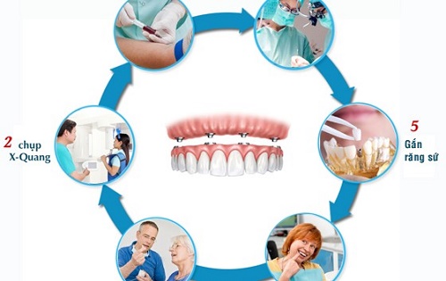 Quy trình điều trị implant 2
