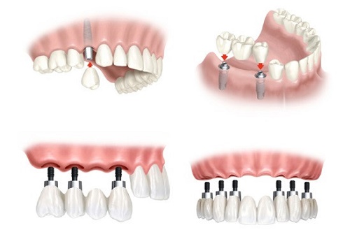 Cấy ghép răng implant là gì? 3 Cấy ghép răng implant là gì? 3